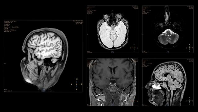 Head MRI scan from different angles. Top view and side view of brain MRI scan
