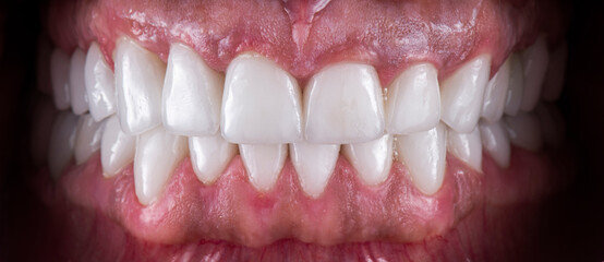 dental job photography, crowns veneers implants