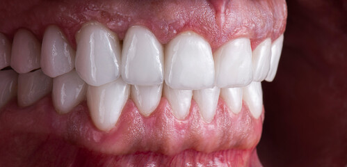 dental job photography, crowns veneers implants