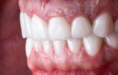 dental job photography, crowns veneers implants