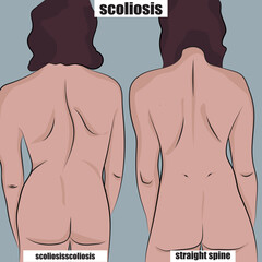 Vector illustration of scoliosis in adults, before and after. - obrazy, fototapety, plakaty