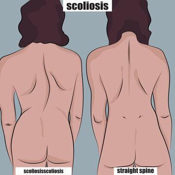 Vector illustration of scoliosis in adults, before and after.
