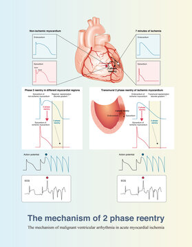 In the early stage of transmural myocardial ischemia, the mechanism of ventricular arrhythmia is mainly 2 phase reentry, including between ischemic and non ischemic areas  and transmural reentry.