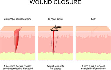 Wound closure. From surgical or traumatic wound to suture and scar.
