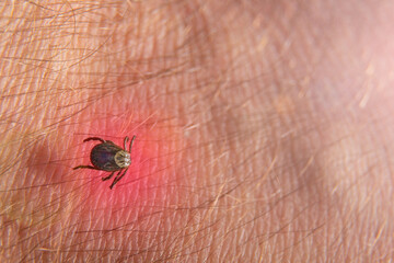 Crawling deer tick on the background of human hairy skin.