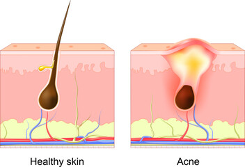 Acne pimple. normal hair follicle and clogged pore.