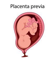 Placental previa. Fetus in Uterus During Pregnancy. Pregnancy women anatomy. Fetus with umbilical cord and placenta.
Usual anatomical Placenta Location. Detailed medical vector illustration.

