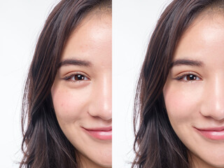 Beautiful woman Asia before and after acne treatment No makeup, close up. Skin care concept White...