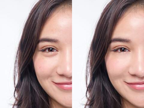 Beautiful woman Asia before and after acne treatment No makeup, close up. Skin care concept White background