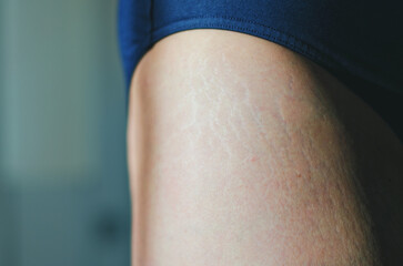 Stretch marks on legs after weight loss close up. Background and texture. Skin care. Active sport. Healthy lifestyle. Beauty. 