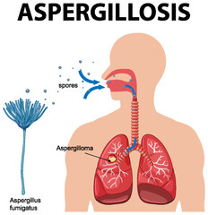 Diagram showing aspergillus infection