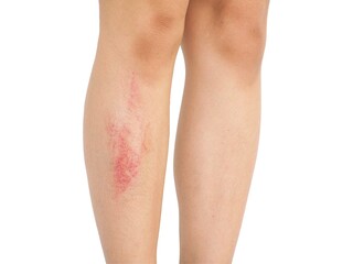 Young woman have bruise on right leg  from accident on white background. Closeup photo, blurred.