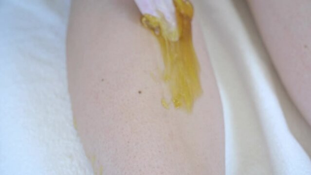 sugerring hair removal