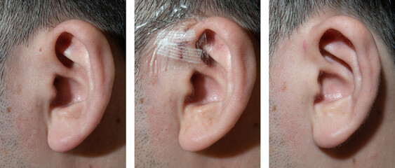 耳瘻孔（左から術前、手術直後、術後半年。30代男性）Before and after surgery for  fistula auris congenita.