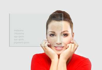 Dark spots, freckles,hyperpigmentation(melasma or chloasma),concept - skin lightening, skin...