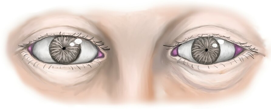 The normal diameter of pupil, the dilated pupil in midbrain lesion and the pinpoint pupil in pontine lesion.