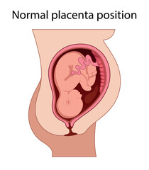 Different Placental Locations.  Fetus in Uterus During Pregnancy. Normal, top, low previa and front position.  
Pathology. Detailed medical vector illustration.
