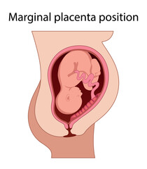 Obraz premium Different Placental Locations. Fetus in Uterus During Pregnancy. Normal, top, low previa and front position. Pathology. Detailed medical vector illustration. 