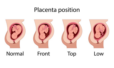 Different Placental Locations.  Fetus in Uterus During Pregnancy. Normal, top, low previa and front position.  
Pathology. Detailed medical vector illustration.
