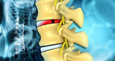 Human spine disc bulge. 3d illustration.. - obrazy, fototapety, plakaty