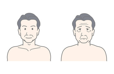 中年男性・おじさんの顔　老化　しわ・たるみ　ビフォーアフター