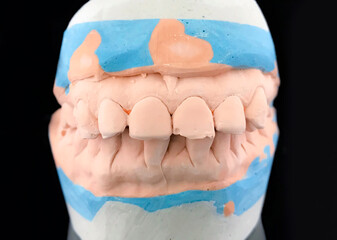 Plaster casting model on black background. Close up dental plaster mould of the dentist. Front view. Selective focus. Lower and upper jaw in metal occluder. Dental gypsum model of teeth in dental © Alice
