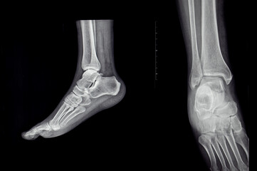 an x-ray of the sole of the human foot