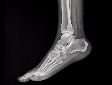 an x-ray of the sole of the human foot