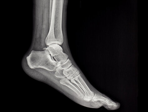 X-rays of the human foot