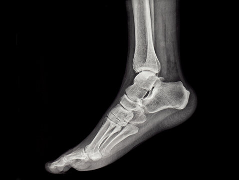 An x-ray of the human foot and ankle