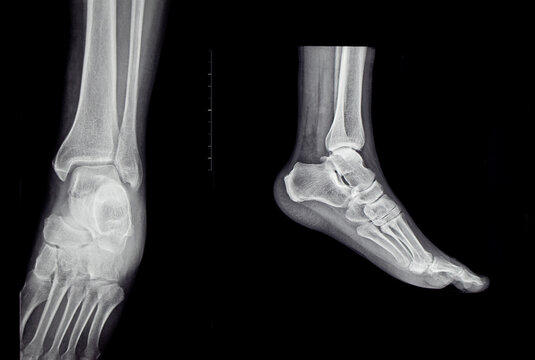 X-rays of the human foot from two angles