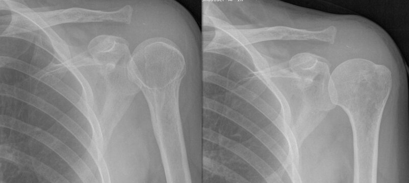 x ray image of absence of the acromion
