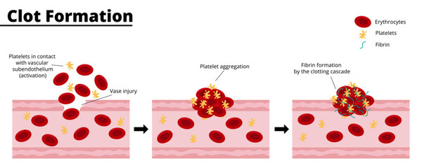 Clot formation process after a bleeding vascular injury. Platelet aggregate formation. Formation of fibrin by the clotting cascade. Vector illustration. Didactic illustration.
 - obrazy, fototapety, plakaty