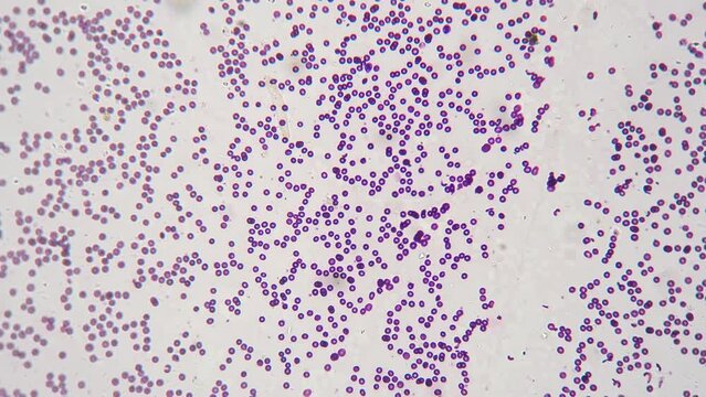 Smear of human blood under microscope with 200 times magnification on bright field. Erythrocytes and monocytes educated in medical lab. Studying hematology for helping people health. Immune system