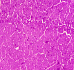 Scrotal wall(biopsy): Calcinosis cutis, show skin, subepithelial tissue of extensive calcification....