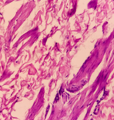 Scrotal wall(biopsy): Calcinosis cutis, show skin, subepithelial tissue of extensive calcification. histology image analyzed by light microscope.