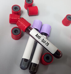 Blood sample for Anti Scl70 (Scleroma 70) test, diagnosis for autoimmune disorders, systemic sclerosis, ENA panel test.