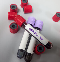 Blood sample for Anti SS B (La) test, diagnosis for autoimmune disorders, ENA profile test.