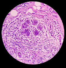 Photomicrograph of breast abscess, Granulomatous mastitis, show dense infiltration of...