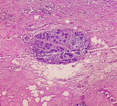 Photomicrograph Of Breast Abscess, Granulomatous Mastitis, Show Dense Infiltration Of Polymorphs,lymphocytes, Histiocyte,epithelioid Cells,plasma Cells,fibroblast.