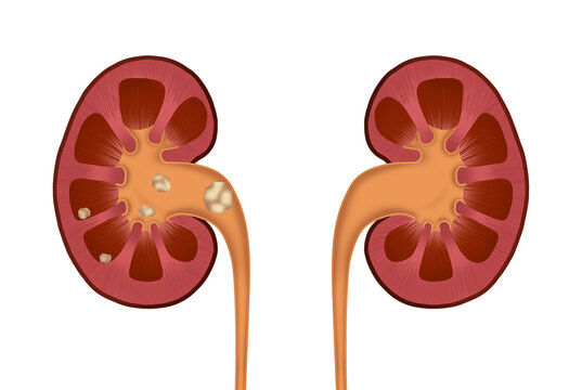 Illustration of human kidney stones on white background