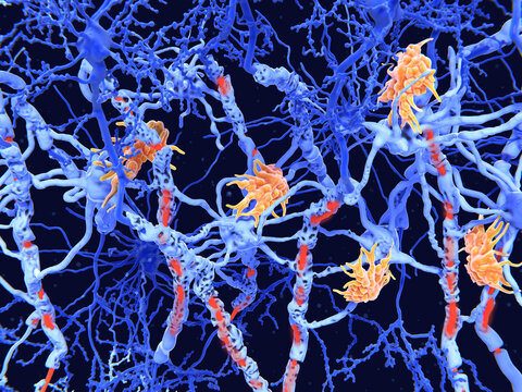 Multiple sclerosis (MS): microglia cells damage the myelin sheath of neuron axons. The demyelinated axons are depicted red.