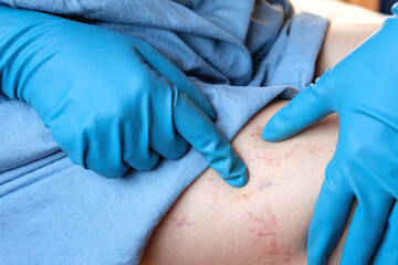 Phlebologist examines a patient with varicose veins on his leg. Leg pain. Phlebology. Venous...