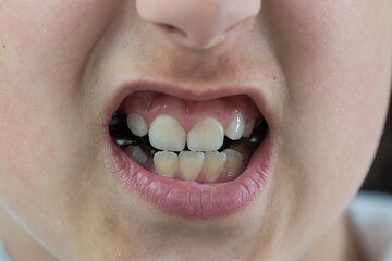 a little girl with a shifted dentition demonstrates her teeth