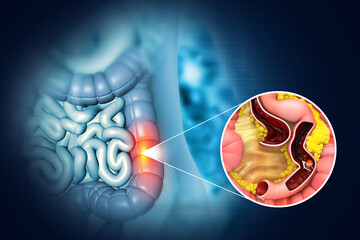 Colon cancer. Colon Polyp Removal. Endoscope inside colonoscopy for Colon polyps search. 3d illustration - obrazy, fototapety, plakaty