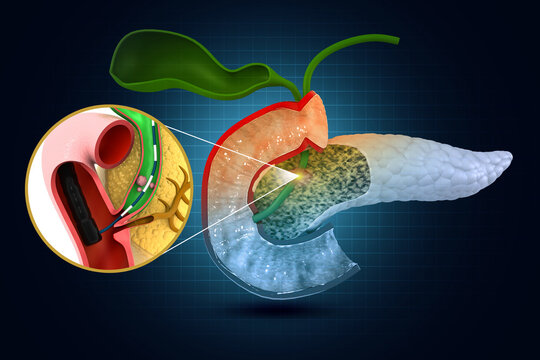 Gallstones removing in the Gallbladder. 3d illustration