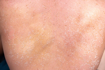 Fototapeta premium Sunburn, close-up of human skin. Flaky skin from allergies, peeling or eczema. Dry skin in need of treatment and hydration.