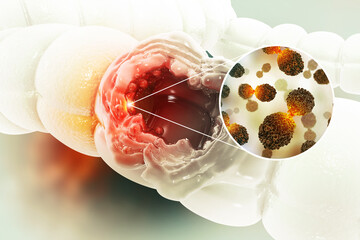 Colon cancer. Cancer attacking cell. Colon disease concept. 3d illustration - obrazy, fototapety, plakaty