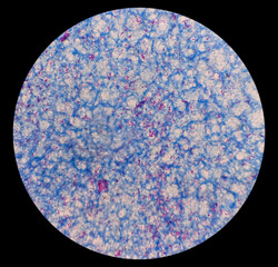 Microscopic 100x image of AFB stainig. Microbacterium Tuberculosis Bacteria (MTB). Sputum or phlegm smear.