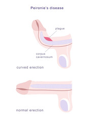 Medical chart of Peyronie's disease. Side view of human penis in normal erection and curved, demonstrating fibrous plague on its erectile tissue. - obrazy, fototapety, plakaty